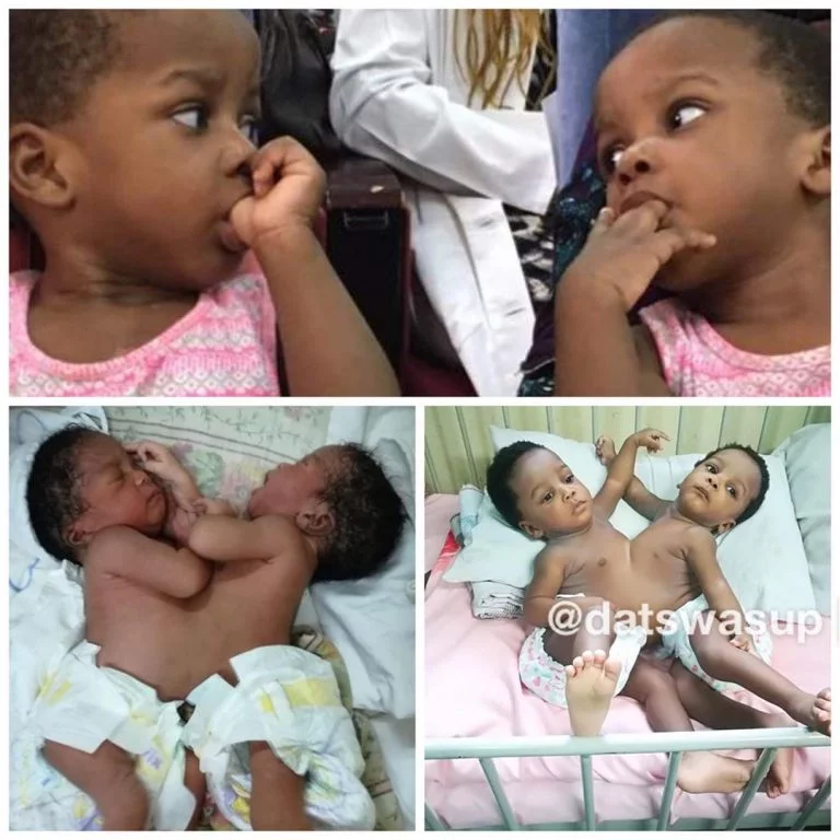 Prof Emmanuel Ameh of ABU Zaria leads team to conduct successful separation of conjoined twins