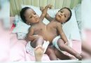 Prof Emmanuel Ameh of ABU Zaria leads team to conduct successful separation of conjoined twins 8 Prof Emmanuel Ameh of ABU Zaria leads team to conduct successful separation of conjoined twins 7
