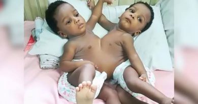 Prof Emmanuel Ameh of ABU Zaria leads team to conduct successful separation of conjoined twins 4