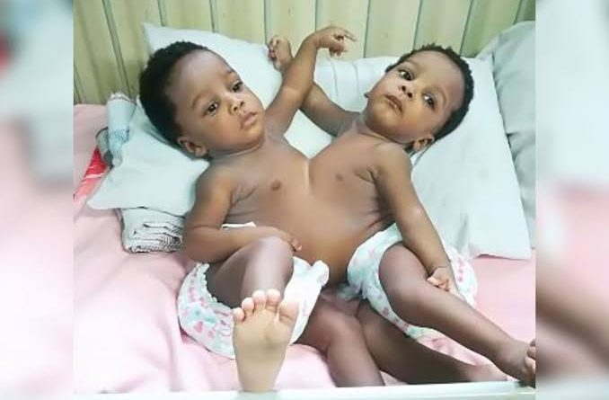 Prof Emmanuel Ameh of ABU Zaria leads team to conduct successful separation of conjoined twins 7
